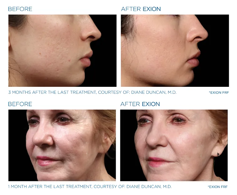 exion-rf-before-and-after